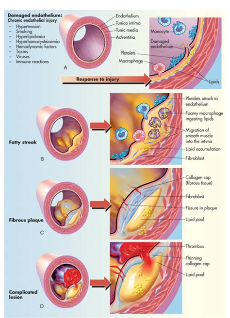 what is the impact of arteriosclerosis quizlet topic test|causes of atherosclerosis include quizlet.